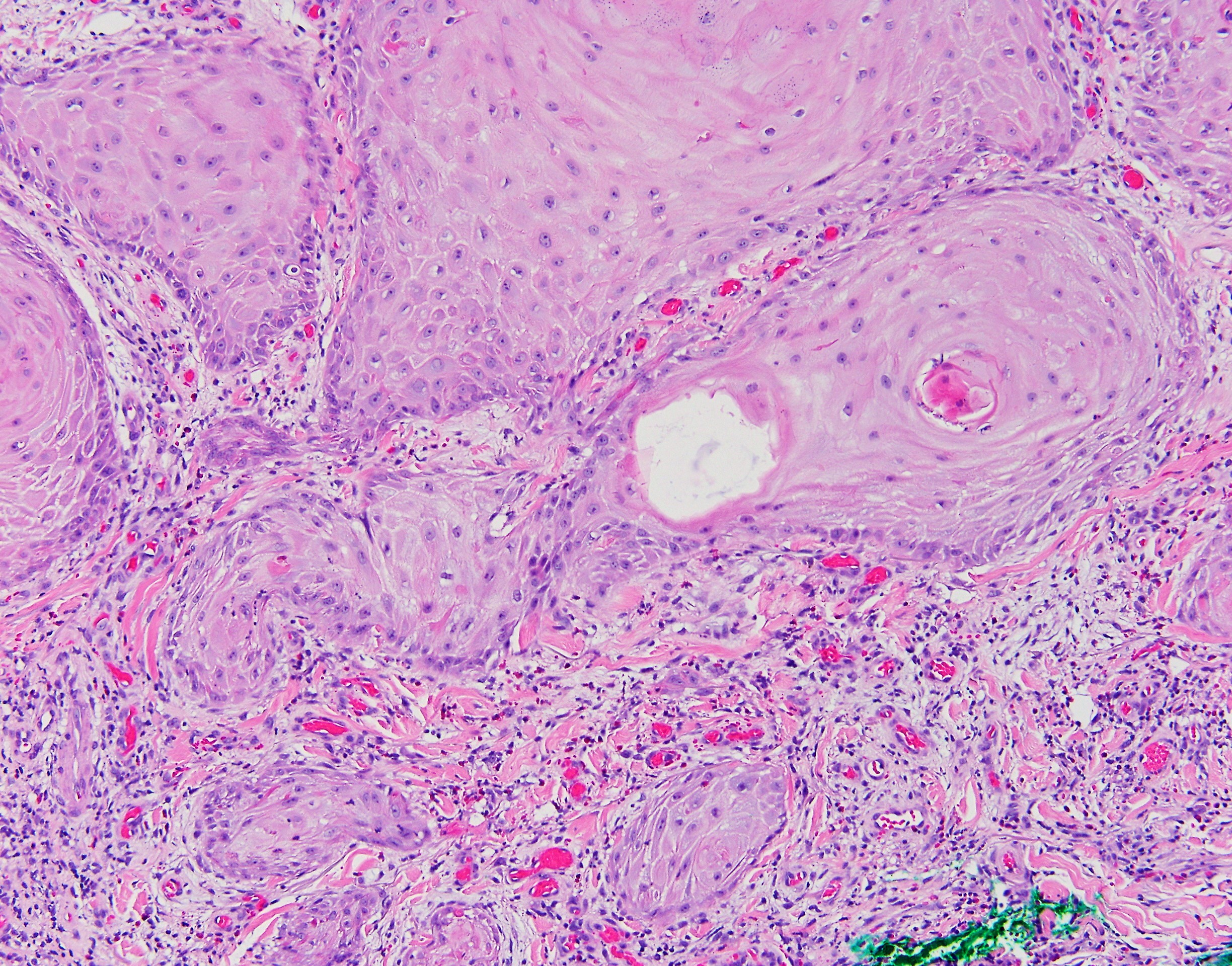 Squamous Cell Carcinoma Global Pathology Teaching And Education Program